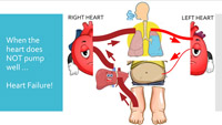 A graphic provides an overview of heart failure and its effect on the body.